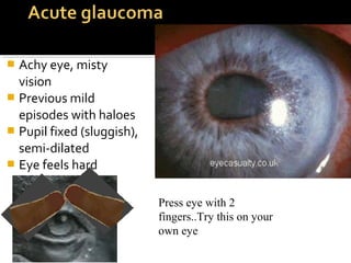  Achy eye, misty
vision
 Previous mild
episodes with haloes
 Pupil fixed (sluggish),
semi-dilated
 Eye feels hard
Press eye with 2
fingers..Try this on your
own eye
 