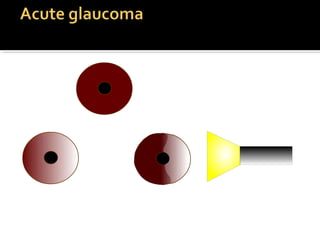 n o r m a l s h a llo w
a n t e r io r
c h a m b e r
 