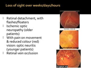  Retinal detachment, with
flashes/floaters
 Ischemic optic
neuropathy (older
patients)
 With pain on movement
& reduced colour (red)
vision: optic neuritis
(younger patients)
 Retinal vein occlusion
 