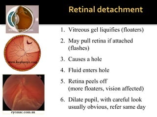 1. Vitreous gel liquifies (floaters)
2. May pull retina if attached
(flashes)
3. Causes a hole
4. Fluid enters hole
5. Retina peels off
(more floaters, vision affected)
6. Dilate pupil, with careful look
usually obvious, refer same day
 