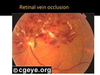 Retinal vein occlusion
 