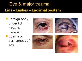  Foreign body
under lid
 Double
eversion
 Edema or
ecchymosis of
lids
Eye & major trauma
 