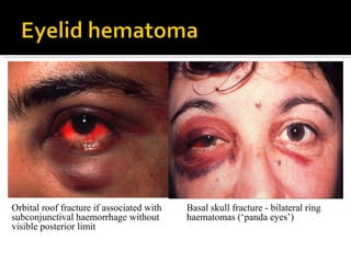 Orbital roof fracture if associated with
subconjunctival haemorrhage without
visible posterior limit
Basal skull fracture - bilateral ring
haematomas (‘panda eyes’)
 