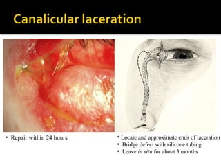 • Repair within 24 hours • Locate and approximate ends of laceration
• Bridge defect with silicone tubing
• Leave in situ for about 3 months
 