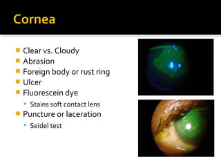  Clear vs. Cloudy
 Abrasion
 Foreign body or rust ring
 Ulcer
 Fluorescein dye
 Stains soft contact lens
 Puncture or laceration
 Seidel test
 