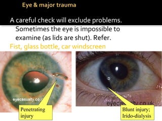 A careful check will exclude problems.
Sometimes the eye is impossible to
examine (as lids are shut). Refer.
Fist, glass bottle, car windscreen
Blunt injury;
Irido-dialysis
Penetrating
injury
 