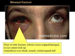 Floor of orbit fracture; inferior rectus trapped/damaged,
so eye cannot look up
Anaesthesia over cheek: assault, cricket/squash ball
 