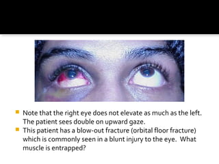  Note that the right eye does not elevate as much as the left.
The patient sees double on upward gaze.
 This patient has a blow-out fracture (orbital floor fracture)
which is commonly seen in a blunt injury to the eye. What
muscle is entrapped?
 