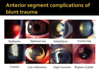 Sphincter tear
Cataract Angle recession
Hyphaema
Lens subluxation
Iridodialysis Vossius ring
Rupture of globe
 