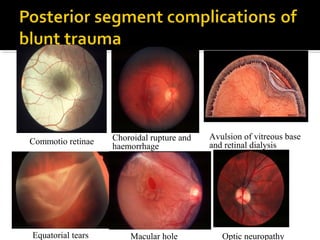 Macular hole Optic neuropathyEquatorial tears
Choroidal rupture and
haemorrhage
Commotio retinae
Avulsion of vitreous base
and retinal dialysis
 