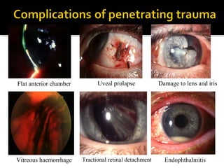 Flat anterior chamber
Vitreous haemorrhage
Damage to lens and iris
EndophthalmitisTractional retinal detachment
Uveal prolapse
 