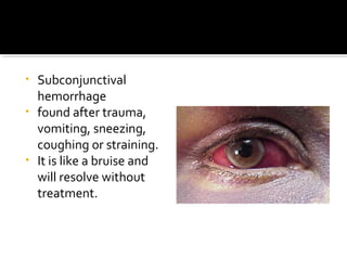 • Subconjunctival
hemorrhage
• found after trauma,
vomiting, sneezing,
coughing or straining.
• It is like a bruise and
will resolve without
treatment.
 