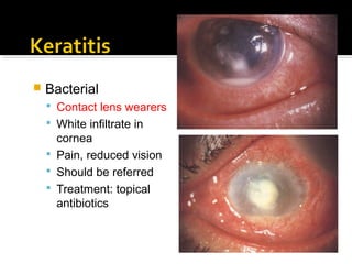  Bacterial
 Contact lens wearers
 White infiltrate in
cornea
 Pain, reduced vision
 Should be referred
 Treatment: topical
antibiotics
 