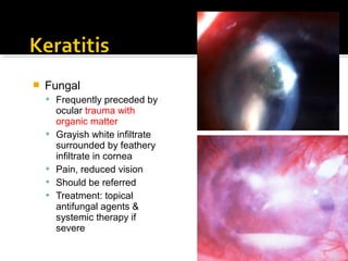  Fungal
 Frequently preceded by
ocular trauma with
organic matter
 Grayish white infiltrate
surrounded by feathery
infiltrate in cornea
 Pain, reduced vision
 Should be referred
 Treatment: topical
antifungal agents &
systemic therapy if
severe
 