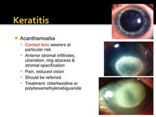 Acanthamoeba
 Contact lens wearers at
particular risk
 Anterior stromal infiltrates,
ulceration, ring abscess &
stromal opacification
 Pain, reduced vision
 Should be referred
 Treatment: chlorhexidine or
polyhexamethylenebiguanide
 