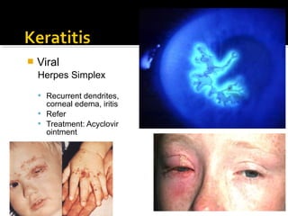  Viral
Herpes Simplex
 Recurrent dendrites,
corneal edema, iritis
 Refer
 Treatment: Acyclovir
ointment
 