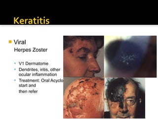  Viral
Herpes Zoster
 V1 Dermatome
 Dendrites, iritis, other
ocular inflammation
 Treatment: Oral Acyclovir;
start and
then refer
 