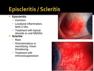  Episcleritis:
 Common
 Localized inflammation,
lasts 2 wks.
 Treatment with topical
steroids or oral NSAIDs
 Scleritis:
 Rare
 Granulomatous or
necrotizing, Vision
threatening.
 Treatment with
immunosuppression
 