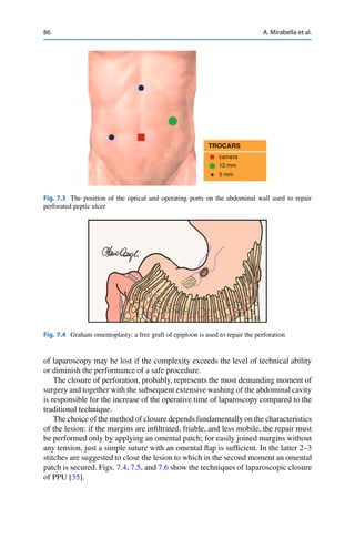 86 A. Mirabella et al.
TROCARS
camera
12 mm
5 mm
Fig. 7.3 The position of the optical and operating ports on the abdominal wall used to repair
perforated peptic ulcer
Fig. 7.4 Graham omentoplasty: a free graft of epiploon is used to repair the perforation
of laparoscopy may be lost if the complexity exceeds the level of technical ability
or diminish the performance of a safe procedure.
The closure of perforation, probably, represents the most demanding moment of
surgery and together with the subsequent extensive washing of the abdominal cavity
is responsible for the increase of the operative time of laparoscopy compared to the
traditional technique.
The choice of the method of closure depends fundamentally on the characteristics
of the lesion: if the margins are inﬁltrated, friable, and less mobile, the repair must
be performed only by applying an omental patch; for easily joined margins without
any tension, just a simple suture with an omental ﬂap is sufﬁcient. In the latter 2–3
stitches are suggested to close the lesion to which in the second moment an omental
patch is secured. Figs. 7.4, 7.5, and 7.6 show the techniques of laparoscopic closure
of PPU [35].
 