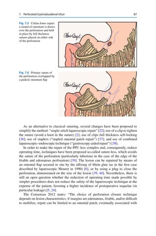 7 Perforated Gastroduodenal Ulcer 87
Fig. 7.5 Cellan-Jones repair:
a strand of omentum is drawn
over the perforation and held
in place by full thickness
sutures placed on either side
of the perforation
Fig. 7.6 Primary suture of
the perforation overlapped by
a pedicle omentum ﬂap
As an alternative to classical suturing, several changes have been proposed to
simplify the method: “single-stitch laparoscopic repair” [22]; use of a clip to tighten
the suture (avoid a knot in the suture) [2]; use of clips full thickness self-locking
[36]; use of staplers (“stapled omental patch repair”) [37]; and use of combined
laparoscopic–endoscopic technique (“gastroscopy-aided repair”) [38].
In order to make the repair of the PPU less complex and, consequently, reduce
operating time, techniques have been proposed so-called suture-less, which avoids
the suture of the perforation (particularly laborious in the case of the edge of the
friable and edematous perforation) [39]. The lesion can be repaired by means of
an omental ﬂap secured in situ by the afﬁxing of ﬁbrin glue (as in the ﬁrst case
described by laparoscopic Mouret in 1990) [6], or by using a plug to close the
perforation, dimensioned on the size of the lesion [39, 40]. Nevertheless, there is
still an open question whether the reduction of operating time made possible by
simpler procedures does not reduce the safety of the laparoscopic technique at the
expense of the patient, favoring a higher incidence of postoperative sequelae (in
particular leakage) [5, 24].
The Consensus 2012 states: “The choice of perforation closure technique
depends on lesion characteristics: if margins are edematous, friable, and/or difﬁcult
to mobilize, repair can be limited to an omental patch, eventually associated with
 