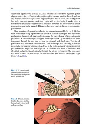 96 A. Mirabella et al.
successful laparoscopic-assisted NOTES omental and falciform ligament patch
closure, respectively. Postoperative radiographic contrast studies showed no leak
and patients were discharged home on postoperative days 3 and 4. The third patient
had undergone enterocutaneous ﬁstula repair with herniorrhaphy 6 weeks prior; a
transluminal endoscopic approach was feasible; however, the omentum was under
too much tension to be secured. This procedure was converted to an open omental-
patch repair.
After induction of general anesthesia, pneumoperitoneum (12–14 cm H2O) has
been established using a periumbilical trocar in Hasson technique. This served to
conﬁrm the diagnosis of ulcer perforation and for surveillance of the endoscopic
procedure. A standard diagnostic upper endoscope with CO2 insufﬂation has been
introduced through the oro-pharynx into the stomach and duodenum. The site of
perforation was identiﬁed and measured. The endoscope was carefully advanced
through the perforation when possible. Once in the peritoneal cavity, the endoscopist
proceeded with inspection and irrigation. A viable mobile piece of omentum was
identiﬁed and pulled intraluminally through the site of perforation. The omentum
was then ﬁxed to the mucosa of the luminal wall with several endoscopic clips
(Figs. 7.7 and 7.8).
Fig. 7.7 A viable mobile
piece of omentum pulled
intraluminally through the
site of perforation
Fig. 7.8 The omentum is
ﬁxed to the mucosa of the
luminal wall with several
endoscopic clips
 