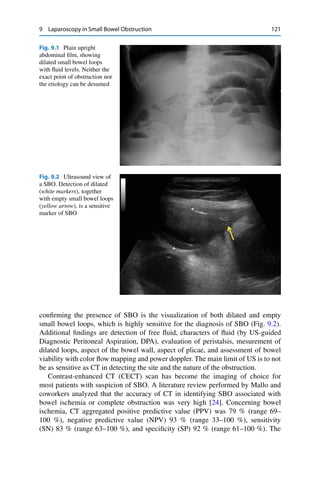9 Laparoscopy in Small Bowel Obstruction 121
Fig. 9.1 Plain upright
abdominal ﬁlm, showing
dilated small bowel loops
with ﬂuid levels. Neither the
exact point of obstruction nor
the etiology can be desumed
Fig. 9.2 Ultrasound view of
a SBO. Detection of dilated
(white markers), together
with empty small bowel loops
(yellow arrow), is a sensitive
marker of SBO
conﬁrming the presence of SBO is the visualization of both dilated and empty
small bowel loops, which is highly sensitive for the diagnosis of SBO (Fig. 9.2).
Additional ﬁndings are detection of free ﬂuid, characters of ﬂuid (by US-guided
Diagnostic Peritoneal Aspiration, DPA), evaluation of peristalsis, mesurement of
dilated loops, aspect of the bowel wall, aspect of plicae, and assessment of bowel
viability with color ﬂow mapping and power doppler. The main limit of US is to not
be as sensitive as CT in detecting the site and the nature of the obstruction.
Contrast-enhanced CT (CECT) scan has become the imaging of choice for
most patients with suspicion of SBO. A literature review performed by Mallo and
coworkers analyzed that the accuracy of CT in identifying SBO associated with
bowel ischemia or complete obstruction was very high [24]. Concerning bowel
ischemia, CT aggregated positive predictive value (PPV) was 79 % (range 69–
100 %), negative predictive value (NPV) 93 % (range 33–100 %), sensitivity
(SN) 83 % (range 63–100 %), and speciﬁcity (SP) 92 % (range 61–100 %). The
 