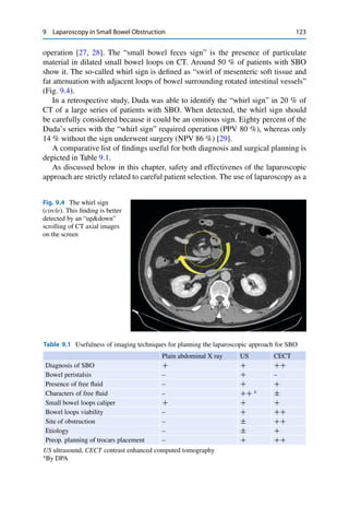 9 Laparoscopy in Small Bowel Obstruction 123
operation [27, 28]. The “small bowel feces sign” is the presence of particulate
material in dilated small bowel loops on CT. Around 50 % of patients with SBO
show it. The so-called whirl sign is deﬁned as “swirl of mesenteric soft tissue and
fat attenuation with adjacent loops of bowel surrounding rotated intestinal vessels”
(Fig. 9.4).
In a retrospective study, Duda was able to identify the “whirl sign” in 20 % of
CT of a large series of patients with SBO. When detected, the whirl sign should
be carefully considered because it could be an ominous sign. Eighty percent of the
Duda’s series with the “whirl sign” required operation (PPV 80 %), whereas only
14 % without the sign underwent surgery (NPV 86 %) [29].
A comparative list of ﬁndings useful for both diagnosis and surgical planning is
depicted in Table 9.1.
As discussed below in this chapter, safety and effectivenes of the laparoscopic
approach are strictly related to careful patient selection. The use of laparoscopy as a
Fig. 9.4 The whirl sign
(circle). This ﬁnding is better
detected by an “up&down”
scrolling of CT axial images
on the screen
Table 9.1 Usefulness of imaging techniques for planning the laparoscopic approach for SBO
Plain abdominal X ray US CECT
Diagnosis of SBO C C CC
Bowel peristalsis – C –
Presence of free ﬂuid – C C
Characters of free ﬂuid – CC a
˙
Small bowel loops caliper C C C
Bowel loops viability – C CC
Site of obstruction – ˙ CC
Etiology – ˙ C
Preop. planning of trocars placement – C CC
US ultrasound, CECT contrast enhanced computed tomography
a
By DPA
 