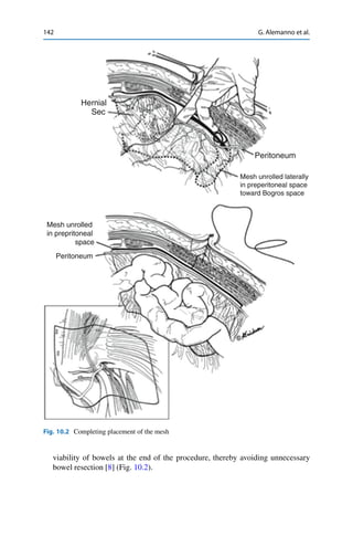 142 G. Alemanno et al.
Hernial
Sec
Peritoneum
Mesh unrolled laterally
in preperitoneal space
toward Bogros space
Mesh unrolled
in prepritoneal
space
Peritoneum
Fig. 10.2 Completing placement of the mesh
viability of bowels at the end of the procedure, thereby avoiding unnecessary
bowel resection [8] (Fig. 10.2).
 