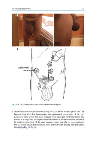 10 Incarcerated Hernias 143
Fig. 10.3 (a) Giant inguino-scrotal hernia. (b) Placement of ports
2. Hybrid laparoscopic/laparotomic using the TEP. Other authors prefer the TEP
because they feel that laparoscopic extra-peritoneal preparation of the pre-
peritoneal ﬂoor avoids the usual struggle of an open pre-peritoneal repair and
results in a larger and better positioned mesh than in an open anterior approach.
In addition, dissection of the cord structures does not rely on invagination of
the sac which makes the dissection more difﬁcult when dealing with the scrotal
hernia [9] (Fig. 10.3a, b)
 