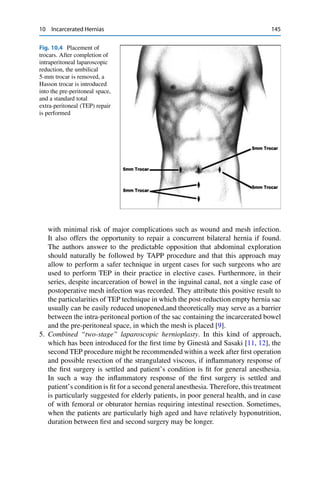 10 Incarcerated Hernias 145
Fig. 10.4 Placement of
trocars. After completion of
intraperitoneal laparoscopic
reduction, the umbilical
5-mm trocar is removed, a
Hasson trocar is introduced
into the pre-peritoneal space,
and a standard total
extra-peritoneal (TEP) repair
is performed
with minimal risk of major complications such as wound and mesh infection.
It also offers the opportunity to repair a concurrent bilateral hernia if found.
The authors answer to the predictable opposition that abdominal exploration
should naturally be followed by TAPP procedure and that this approach may
allow to perform a safer technique in urgent cases for such surgeons who are
used to perform TEP in their practice in elective cases. Furthermore, in their
series, despite incarceration of bowel in the inguinal canal, not a single case of
postoperative mesh infection was recorded. They attribute this positive result to
the particularities of TEP technique in which the post-reduction empty hernia sac
usually can be easily reduced unopened,and theoretically may serve as a barrier
between the intra-peritoneal portion of the sac containing the incarcerated bowel
and the pre-peritoneal space, in which the mesh is placed [9].
5. Combined “two-stage” laparoscopic hernioplasty. In this kind of approach,
which has been introduced for the ﬁrst time by Ginestà and Sasaki [11, 12], the
second TEP procedure might be recommended within a week after ﬁrst operation
and possible resection of the strangulated viscous, if inﬂammatory response of
the ﬁrst surgery is settled and patient’s condition is ﬁt for general anesthesia.
In such a way the inﬂammatory response of the ﬁrst surgery is settled and
patient’s condition is ﬁt for a second general anesthesia. Therefore, this treatment
is particularly suggested for elderly patients, in poor general health, and in case
of with femoral or obturator hernias requiring intestinal resection. Sometimes,
when the patients are particularly high aged and have relatively hyponutrition,
duration between ﬁrst and second surgery may be longer.
 