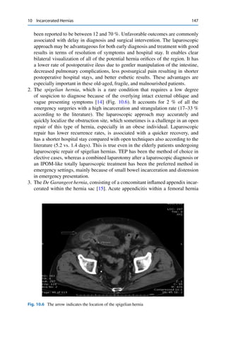 10 Incarcerated Hernias 147
been reported to be between 12 and 70 %. Unfavorable outcomes are commonly
associated with delay in diagnosis and surgical intervention. The laparoscopic
approach may be advantageous for both early diagnosis and treatment with good
results in terms of resolution of symptoms and hospital stay. It enables clear
bilateral visualization of all of the potential hernia oriﬁces of the region. It has
a lower rate of postoperative ileus due to gentler manipulation of the intestine,
decreased pulmonary complications, less postsurgical pain resulting in shorter
postoperative hospital stays, and better esthetic results. These advantages are
especially important in these old-aged, fragile, and malnourished patients.
2. The spigelian hernia, which is a rare condition that requires a low degree
of suspicion to diagnose because of the overlying intact external oblique and
vague presenting symptoms [14] (Fig. 10.6). It accounts for 2 % of all the
emergency surgeries with a high incarceration and strangulation rate (17–33 %
according to the literature). The laparoscopic approach may accurately and
quickly localize the obstruction site, which sometimes is a challenge in an open
repair of this type of hernia, especially in an obese individual. Laparoscopic
repair has lower recurrence rates, is associated with a quicker recovery, and
has a shorter hospital stay compared with open techniques also according to the
literature (5.2 vs. 1.4 days). This is true even in the elderly patients undergoing
laparoscopic repair of spigelian hernias. TEP has been the method of choice in
elective cases, whereas a combined laparotomy after a laparoscopic diagnosis or
an IPOM-like totally laparoscopic treatment has been the preferred method in
emergency settings, mainly because of small bowel incarceration and distension
in emergency presentation.
3. The De Garangeot hernia, consisting of a concomitant inﬂamed appendix incar-
cerated within the hernia sac [15]. Acute appendicitis within a femoral hernia
Fig. 10.6 The arrow indicates the location of the spigelian hernia
 