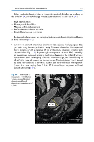 11 Incarcerated Incisional and Ventral Hernias 153
Either randomized control trials or prospective controlled studies are available in
the literature [9], and laparoscopy remains contraindicated in these cases [9] :
– High operative risk
– Hemodynamic instability
– Massive abdominal distension
– Perforation and/or bowel necrosis
– Limited laparoscopic experience
Best cases for laparoscopy are patients with incarcerated ventral incisional hernia
in these situations [9–11]:
• Absence of marked abdominal distension with reduced working space that
precludes entry into the peritoneal cavity. Moderate abdominal distension and
bowel distension with a diameter <5 cm are favorable situations with low risk
of conversion (Fig. 11.1). Laparoscopic management of acute SBO caused by
an incarcerated incisional hernia is challenging because of the reduced working
space due to ileus, the fragility of dilated intestinal loops, and the difﬁculty to
identify the cause of obstruction in some cases. Manipulation of bowel should
be done very carefully as intestinal injuries can have disastrous consequences
(conversion rates ranging from 0 % to 52 % according to surgeon’s skill and
patient selection) [9–14].
Fig. 11.1 Abdomen CT:
incarcerated ventral hernia
with moderate abdominal
distension and bowel
distension with a diameter of
4.2 cm
 