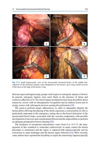11 Incarcerated Incisional and Ventral Hernias 155
Fig. 11.2 (a–d) Laparoscopic view of the incarcerated incisional hernia of the middle line:
reduction of the intestinal contents with enlargement of the hernia’s port using careful incision
of the fascia at the edge of the hernia’s ring
between open and laparoscopic groups with respect to iatrogenic injuries to bowel.
In general, iatrogenic injuries were more likely in the presence of dense and
extensive adhesions [13]. Two bowel injury mechanisms have been described: direct
trauma by scissor with no intraoperative recognition and an indirect lesion due to
energy source with subsequent necrosis causing the perforation [15].
The need to perform proper adhesiolysis, in order to adequately identify the
hernia defect allowing the placing of the mesh, represents a crucial point [2]; this is
particularly important in the emergency setting due to the bowel distension of the
incarcerated bowel loops, associated with the vascular compromise with possible
development of necrosis and contaminated effusion and the impossibility to perform
an adequate preoperative bowel cleaning [22].
The incidence of recognized enterotomies varies from 6 to 14.3 %; the man-
agement of this condition is somewhat controversial: in many centers the hernia
procedure is terminated and the injury is repaired both laparoscopically and by
conversion to open technique and the hernia repair deferred [23]. Most recently,
some authors have reported the feasibility to repair the enterotomy laparoscopically
 