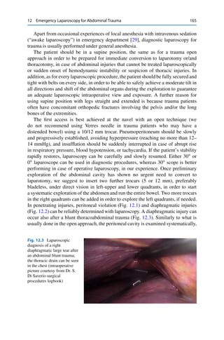 12 Emergency Laparoscopy for Abdominal Trauma 165
Apart from occasional experiences of local anesthesia with intravenous sedation
(“awake laparoscopy”) in emergency department [29], diagnostic laparoscopy for
trauma is usually performed under general anesthesia.
The patient should be in a supine position, the same as for a trauma open
approach in order to be prepared for immediate conversion to laparotomy or/and
thoracotomy, in case of abdominal injuries that cannot be treated laparoscopically
or sudden onset of hemodynamic instability or suspicion of thoracic injuries. In
addition, as for every laparoscopic procedure, the patient should be fully secured and
tight with belts on every side, in order to be able to safely achieve a moderate tilt in
all directions and shift of the abdominal organs during the exploration to guarantee
an adequate laparoscopic intraoperative view and exposure. A further reason for
using supine position with legs straight and extended is because trauma patients
often have concomitant orthopedic fractures involving the pelvis and/or the long
bones of the extremities.
The ﬁrst access is best achieved at the navel with an open technique (we
do not recommend using Verres needle in trauma patients who may have a
distended bowel) using a 10/12 mm trocar. Pneumoperitoneum should be slowly
and progressively established, avoiding hyperpressure (reaching no more than 12–
14 mmHg), and insufﬂation should be suddenly interrupted in case of abrupt rise
in respiratory pressure, blood hypotension, or tachycardia. If the patient’s stability
rapidly restores, laparoscopy can be carefully and slowly resumed. Either 30ı
or
0ı
laparoscope can be used in diagnostic procedures, whereas 30ı
scope is better
performing in case of operative laparoscopy, in our experience. Once preliminary
exploration of the abdominal cavity has shown no urgent need to convert to
laparotomy, we suggest to insert two further trocars (5 or 12 mm), preferably
bladeless, under direct vision in left-upper and lower quadrants, in order to start
a systematic exploration of the abdomen and run the entire bowel. Two more trocars
in the right quadrants can be added in order to explore the left quadrants, if needed.
In penetrating injuries, peritoneal violation (Fig. 12.1) and diaphragmatic injuries
(Fig. 12.2) can be reliably determined with laparoscopy. A diaphragmatic injury can
occur also after a blunt thoracoabdominal trauma (Fig. 12.3). Similarly to what is
usually done in the open approach, the peritoneal cavity is examined systematically,
Fig. 12.3 Laparoscopic
diagnosis of a right
diaphragmatic large tear after
an abdominal blunt trauma;
the thoracic drain can be seen
in the chest (intraoperative
picture courtesy from Dr. S.
Di Saverio surgical
procedures logbook)
 