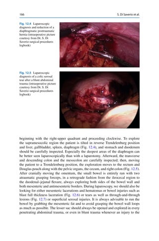 166 S. Di Saverio et al.
Fig. 12.4 Laparoscopic
diagnosis and reduction of a
diaphragmatic posttraumatic
hernia (intraoperative picture
courtesy from Dr. S. Di
Saverio surgical procedures
logbook)
Fig. 12.5 Laparoscopic
diagnosis of a colic serosal
tear after a blunt abdominal
trauma (intraoperative picture
courtesy from Dr. S. Di
Saverio surgical procedures
logbook)
beginning with the right-upper quadrant and proceeding clockwise. To explore
the supramesocolic region the patient is tilted in reverse Trendelenburg position
and liver, gallbladder, spleen, diaphragm (Fig. 12.4), and stomach and duodenum
should be carefully inspected. Especially the deepest areas of the diaphragm can
be better seen laparoscopically than with a laparotomy. Afterward, the transverse
and descending colon and the mesocolon are carefully inspected; then, moving
the patient to a Trendelenburg position, the exploration moves to the rectum and
Douglas pouch along with the pelvic organs, the cecum, and right colon (Fig. 12.5).
After cranially moving the omentum, the small bowel is entirely run with two
atraumatic grasping forceps, in a retrograde fashion from the ileocecal region to
the duodenal–jejunal ﬂexure, always exploring both sides of the bowel wall and
both mesenteric and antimesenteric borders. During laparoscopy, we should also be
looking for either mesenteric lacerations and hematomas or bowel injuries such as
blast full thickness laceration (Fig. 12.6) or tears as well as through-and-through
lesions (Fig. 12.7) or superﬁcial serosal injuries. It is always advisable to run the
bowel by grabbing the mesenteric fat and to avoid grasping the bowel wall loops
as much as possible. The lesser sac should always be opened and explored in every
penetrating abdominal trauma, or even in blunt trauma whenever an injury to the
 