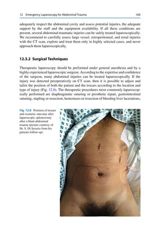 12 Emergency Laparoscopy for Abdominal Trauma 169
adequately inspect the abdominal cavity and assess potential injuries, the adequate
support by the staff and the equipment availability. If all these conditions are
present, several abdominal traumatic injuries can be safely treated laparoscopically.
We recommend to carefully assess large vessel, retroperitoneal, and renal injuries
with the CT scan, explore and treat them only in highly selected cases, and never
approach them laparoscopically.
12.3.2 Surgical Techniques
Therapeutic laparoscopy should be performed under general anesthesia and by a
highly experienced laparoscopic surgeon. According to the expertise and conﬁdence
of the surgeon, many abdominal injuries can be treated laparoscopically. If the
injury was detected preoperatively on CT scan, then it is possible to adjust and
tailor the position of both the patient and the trocars according to the location and
type of injury (Fig. 12.8). The therapeutic procedures most commonly laparoscop-
ically performed are diaphragmatic suturing or prosthetic repair, gastrointestinal
suturing, stapling or resection, hemostasis or resection of bleeding liver lacerations,
Fig. 12.8 Position of trocars
and cosmetic outcome after
laparoscopic splenectomy
after a blunt abdominal
trauma (picture courtesy of
Dr. S. Di Saverio from his
patients follow-up)
 