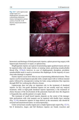 170 S. Di Saverio et al.
Fig. 12.9 (a,b) Laparoscopic
simple repair of a
diaphragmatic laceration after
a penetrating abdominal
trauma (intraoperative picture
courtesy from Dr. S. Di
Saverio surgical procedures
logbook)
hemostasis and drainage of distal pancreatic injuries, spleen-preserving surgery with
laparoscopic hemostasis or repair, or splenectomy.
Diaphragmatic injuries are typical of penetrating upper quadrant trauma and can
be repaired either with single stitches or running suture, preferring nonabsorbable
thread (Fig. 12.9a,b); however, in case of diaphragmatic disruption, prosthetic
nonabsorbable mesh is used to reconstruct the diaphragm. In the majority of cases
chest tube drainage is required.
Gastric injuries occur more often in case of penetrating abdominal trauma. These
injuries can be treated laparoscopically with a simple repair with or without omental
patch, followed by intraoperative testing for leaks using methylene blue injection
through NGT for verifying the effective closure.
Laparoscopy does not play an important role in the treatment of duodenal
injuries. In fact, low-grade duodenal injuries do not usually need any surgical
treatment, while in high-grade duodenal injuries laparotomy is the treatment of
choice because of the involvement of the pancreatic head and since the diagnosis
is frequently late, and the patient is in septic shock.
The treatment of small bowel injuries depends on the extent of the damage:
little perforations with vital margins can be repaired with double layer suturing
(Fig. 12.10); destructive injuries or large defects in the mesenteric side should be
resected and anastomosed (intra- or extracorporeally).
Colon serosal tears usually require just a simple laparoscopic repair (Fig. 12.11),
but if destructive, larger, and full thickness injuries are found, resection and
 