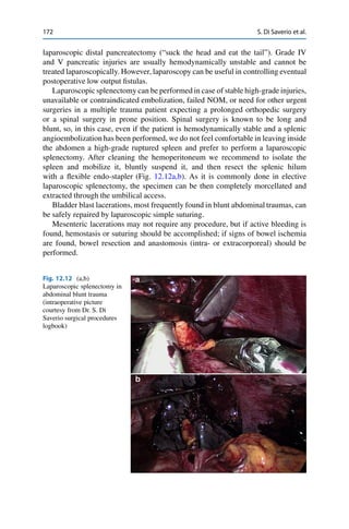 172 S. Di Saverio et al.
laparoscopic distal pancreatectomy (“suck the head and eat the tail”). Grade IV
and V pancreatic injuries are usually hemodynamically unstable and cannot be
treated laparoscopically. However, laparoscopy can be useful in controlling eventual
postoperative low output ﬁstulas.
Laparoscopic splenectomy can be performed in case of stable high-grade injuries,
unavailable or contraindicated embolization, failed NOM, or need for other urgent
surgeries in a multiple trauma patient expecting a prolonged orthopedic surgery
or a spinal surgery in prone position. Spinal surgery is known to be long and
blunt, so, in this case, even if the patient is hemodynamically stable and a splenic
angioembolization has been performed, we do not feel comfortable in leaving inside
the abdomen a high-grade ruptured spleen and prefer to perform a laparoscopic
splenectomy. After cleaning the hemoperitoneum we recommend to isolate the
spleen and mobilize it, bluntly suspend it, and then resect the splenic hilum
with a ﬂexible endo-stapler (Fig. 12.12a,b). As it is commonly done in elective
laparoscopic splenectomy, the specimen can be then completely morcellated and
extracted through the umbilical access.
Bladder blast lacerations, most frequently found in blunt abdominal traumas, can
be safely repaired by laparoscopic simple suturing.
Mesenteric lacerations may not require any procedure, but if active bleeding is
found, hemostasis or suturing should be accomplished; if signs of bowel ischemia
are found, bowel resection and anastomosis (intra- or extracorporeal) should be
performed.
Fig. 12.12 (a,b)
Laparoscopic splenectomy in
abdominal blunt trauma
(intraoperative picture
courtesy from Dr. S. Di
Saverio surgical procedures
logbook)
 