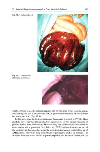 13 Update in Laparoscopic Approach to Acute Mesenteric Ischemia 181
Fig. 13.2 Ischemic bowel
Fig. 13.3 Laparoscopic
abdominal exploration
single operator’s speciﬁc medical records and on the level of his learning curve,
considering also that a low pressure of CO2 pneumoperitoneum is advised if there
is a suspicious AMI (Fig. 13.3).
In this way, since the ﬁrst application of ﬂuorescein proposed in 1993 by Kam
and Scheeres to increase the sensibility of laparoscopy, several studies on canine or
porcine models were proposed [6]. However, only few evidences are collected from
these studies and in particular Paral Jiri et al. (2007) conﬁrmed on porcine model
the feasibility of this procedure using the speciﬁc optical system in the follow-up of
AMI patients. Moreover, there are no trials or perspective studies on humans. The
article of Paral represents the last important experience in the use of ﬂuorescein, but
 