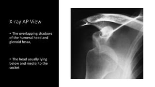 Emergency management of common dislocations | PPTX
