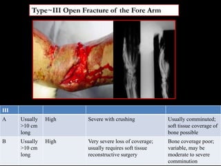Type~III Open Fracture of the Fore Arm
III
A Usually
>10 cm
long
High Severe with crushing Usually comminuted;
soft tissue coverage of
bone possible
B Usually
>10 cm
long
High Very severe loss of coverage;
usually requires soft tissue
reconstructive surgery
Bone coverage poor;
variable, may be
moderate to severe
comminution
 