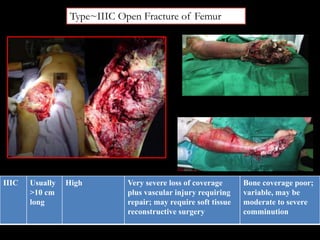 Type~IIIC Open Fracture of Femur
IIIC Usually
>10 cm
long
High Very severe loss of coverage
plus vascular injury requiring
repair; may require soft tissue
reconstructive surgery
Bone coverage poor;
variable, may be
moderate to severe
comminution
 