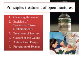 Principles treatment of open fractures
1. Cleansing the wound
2. Excision of
Devitalized Tissue
(Debridement)
3. Treatment of fracture
4. Closure of the Wound
5. Antibacterial Drugs
6. Prevention of Tetanus
 