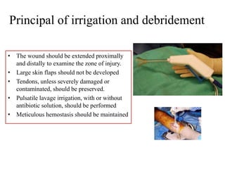 Principal of irrigation and debridement
• The wound should be extended proximally
and distally to examine the zone of injury.
• Large skin flaps should not be developed
• Tendons, unless severely damaged or
contaminated, should be preserved.
• Pulsatile lavage irrigation, with or without
antibiotic solution, should be performed
• Meticulous hemostasis should be maintained
 