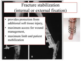 Fracture stabilization
(internal or external fixation)
• provides protection from
additional soft tissue injury,
• maximum access for wound
management,
• maximum limb and patient
mobilization
 