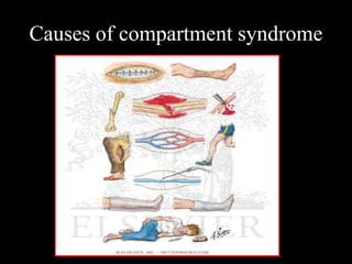 Causes of compartment syndrome
 