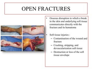 OPEN FRACTURES
• Osseous disruption in which a break
in the skin and underlying soft tissue
communicates directly with the
fracture and its hematoma
• Soft tissue injuries :
– Contamination of the wound and
fracture
– Crushing, stripping, and
devascularization soft tissue
– Destruction or loss of the soft
tissue envelope
 