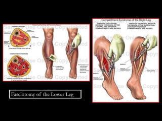 Fasciotomy of the Lower Leg
 