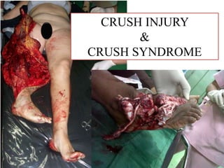 CRUSH INJURY
&
CRUSH SYNDROME
 