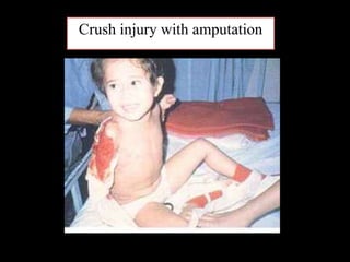 Crush injury with amputation
 